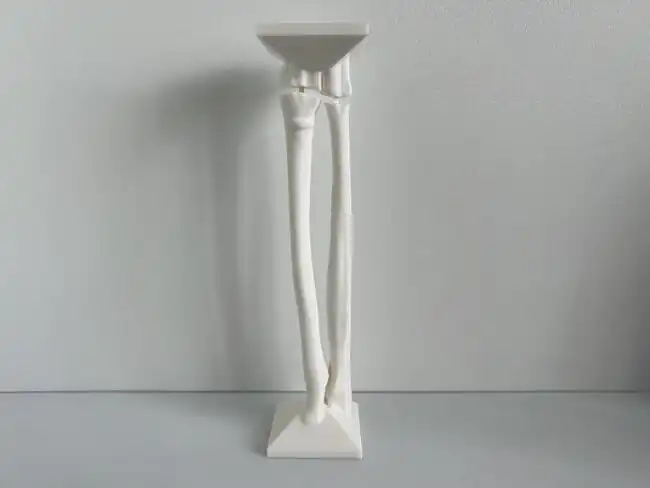 Buckle (Torus) Fracture of Pediatric Female Left Distal Radius