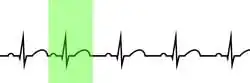 Figure 1. Sinus rhythm with a highlighted premature atrial contraction (PAC).