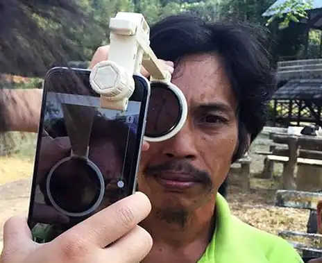 OphthalmicDocs Fundus - a 3D printed universal smartphone retinal imaging adapter.