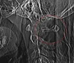 Mary 24th CT scan showing no breakage.