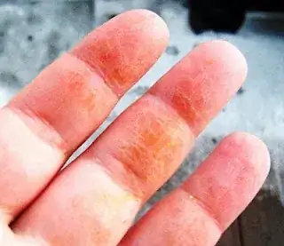 orange skin reaction to squash