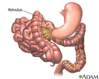Volvulus Volvulus