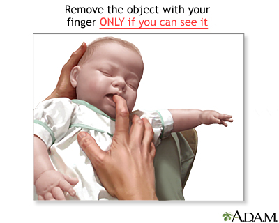 Heimlich maneuver on infant Heimlich maneuver on infant