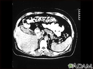 Cholecystitis, CT scan Cholecystitis, CT scan