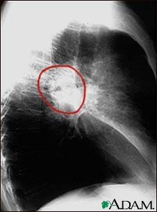 Lung cancer - lateral chest x-ray Lung cancer - lateral chest x-ray