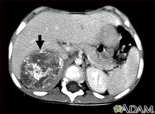 Neuroblastoma in the liver - CT scan Neuroblastoma in the liver - CT scan
