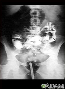 Volvulus - X-ray Volvulus - X-ray