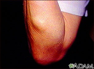 Lipoma - arm Lipoma - arm