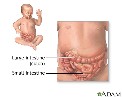 Intestinal obstruction (pediatric) - series Intestinal obstruction (pediatric) - series