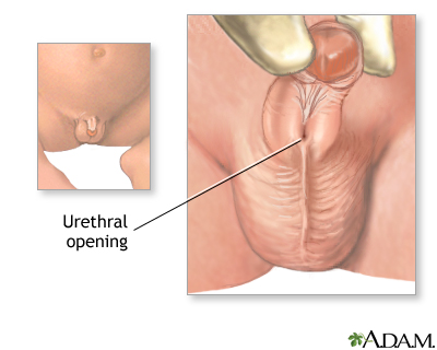 Hypospadias - Indications