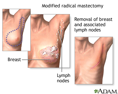 Mastectomy - Procedure part 2