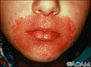 Candidiasis, cutaneous - around the mouth Candidiasis, cutaneous - around the mouth