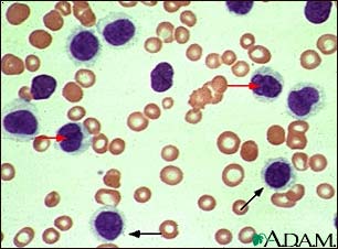 Hairy cell leukemia - microscopic view Hairy cell leukemia - microscopic view