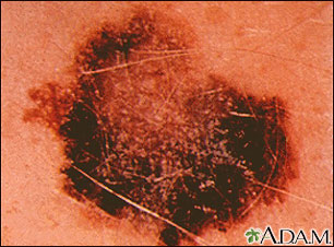 Skin cancer, melanoma - flat, brown lesion Skin cancer, melanoma - flat, brown lesion