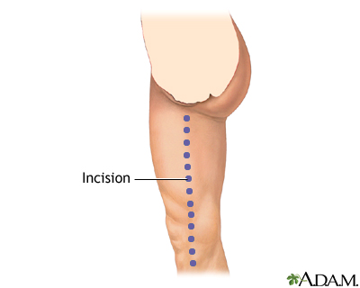 Incision Incision