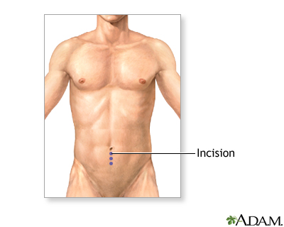 Incision Incision