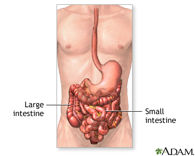 Intestinal obstruction repair - series Intestinal obstruction repair - series