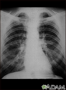 Coal worker's lungs - chest x-ray Coal worker's lungs - chest x-ray
