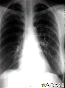 Coccidioidomycosis - chest X-ray Coccidioidomycosis - chest X-ray