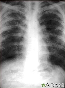 Sarcoid, stage II - chest X-ray Sarcoid, stage II - chest X-ray