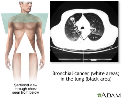 Bronchial cancer - CT scan Bronchial cancer - CT scan