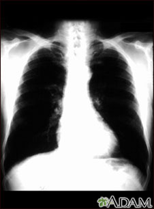 Bronchial cancer - chest X-ray Bronchial cancer - chest X-ray