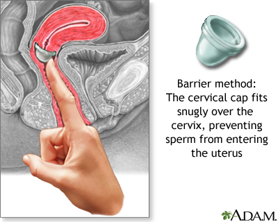 The cervical cap The cervical cap