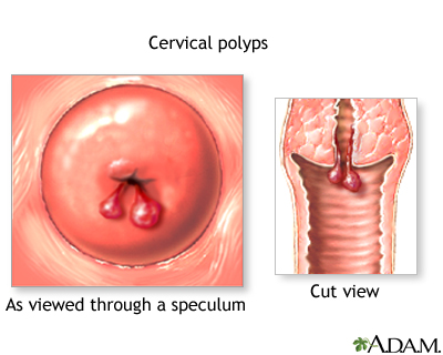 Cervical polyps Cervical polyps