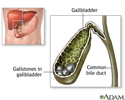 Cholelithiasis Cholelithiasis