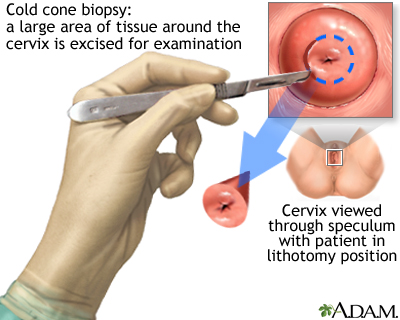 Cold cone biopsy Cold cone biopsy