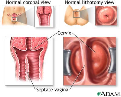 Developmental disorders of the vagina and vulva