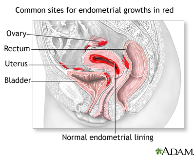 Endometriosis Endometriosis