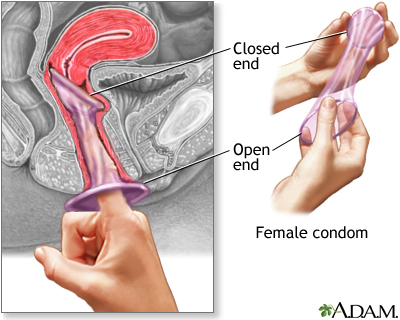 The female condom The female condom