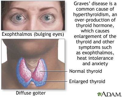 Graves disease Graves disease