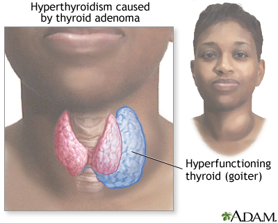 Goiter Goiter