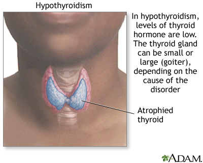 Hypothyroidism Hypothyroidism