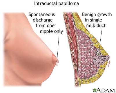Intraductal papilloma Intraductal papilloma