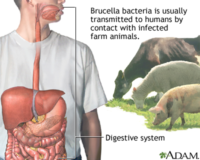 Brucellosis Brucellosis