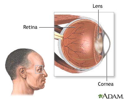 CMV retinitis CMV retinitis