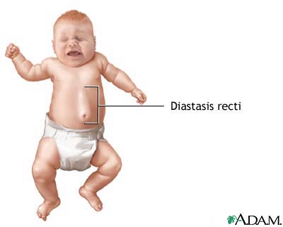Diastasis recti Diastasis recti