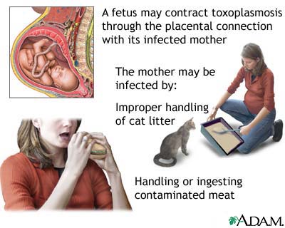 Congenital toxoplasmosis Congenital toxoplasmosis