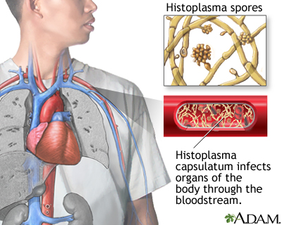 Disseminated histoplasmosis Disseminated histoplasmosis