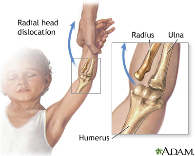 Radial head injury Radial head injury