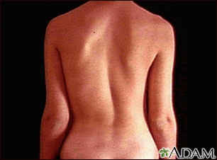 Scoliosis Scoliosis