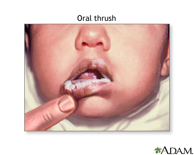 Oral thrush Oral thrush