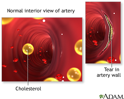 Blockage in internal carotid artery