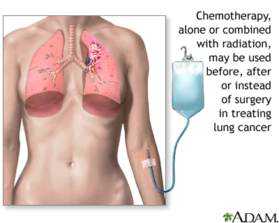 Lung cancer - chemotherapy treatment Lung cancer - chemotherapy treatment