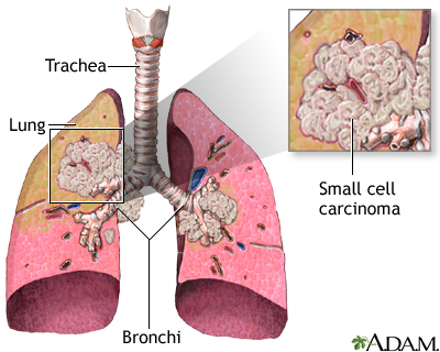 Small cell carcinoma Small cell carcinoma