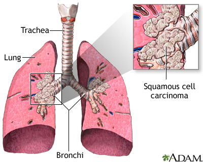 Squamous cell carcinoma Squamous cell carcinoma