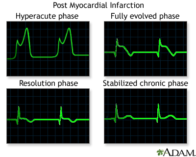 Post myocardial infarction ECG wave tracings Post myocardial infarction ECG wave tracings